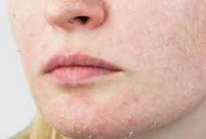  Cara Atasi Efek Buruk dari Skincare Salah Satunya Kulit Mengelupas 