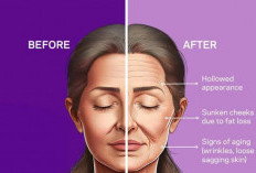 Apa Itu Ozempic Face? Ini Efek Samping Suntikan pada Wajah