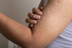 3 Cara Mengatasi Keratosis Pilaris di Badan!