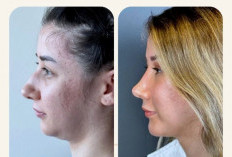 Cara Efektif Menghilangkan Double Chin