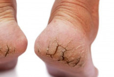 4  Kebiasaan Jarang Disadari Bisa Bikin Tumit Kaki Kering dan Pecah-Pecah!