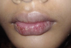 Kenapa Bibir Sering Kering? Ini 3 Penyebab Utamanya