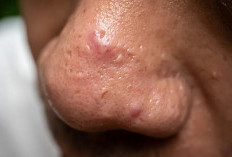 Jerawat Sering Muncul di Area Hidung? Cari Tahu Penyebabnya! 