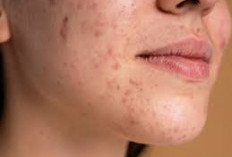 Cara Ampuh Memperbaiki Skin Barrier Rusak Dalam Seminggu 