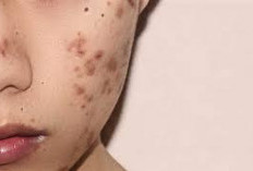   Cara Menghilangkan Bekas Jerawat Hitam, Ini Kandungan yang Dianjurkan