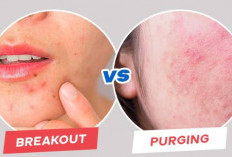 Cara Mencegah Purging di Wajah Setelah Pakai Skincare Baru