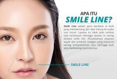 Cara Mengurangi Smile Line Tanpa Operasi