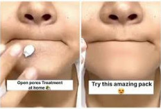 Cara Hilangkan Komedo Hitam dan Bruntusan di Dagu Dengan Gula