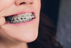 Pakai Behel di Atas Usia 30-an, Apakah Masih Efektif Untuk Gigi?