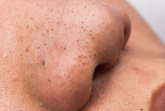 3 Masker Alami Penghilang Komedo Paling Ampuh, Bikin Kulit Mulus 