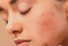 Penyebab Wajah Gatal Setelah Pakai Skincare dan Cara Mengatasinya