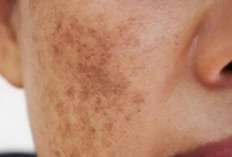 Hindari Flek Hitam Akibat Kosmetik Bermerkuri, Ini Cara Aman