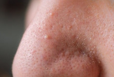 Kenapa Pori-Pori Membesar Setelah Pakai Skincare? Ini Penyebabnya