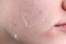 Masalah Kulit Mengelupas saat Musim Hujan, Atasi Dengan 3 Cara Ini