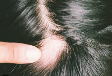 Bukan Pakai Haircare,  Ini Cara Cepat Atasi Rambut Pitak