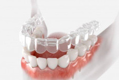 5 Manfaat Merapikan Gigi Dengan Clear Aligner!