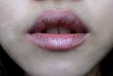 Area Bibir Gelap Karena Hiperpigmentasi, Ini Cara Atasinya