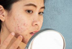 Bahan Dapur Obat Jerawat Alami Paling Cepat Hilang