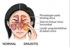 Obati Sinusitis Dengan Menggunakan 5 Bahan Alami Ini