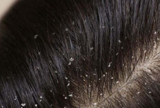  Rambut Gatal dan Berketombe? Ini 5 Penyebabnya!