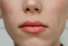 Apakah Herpes Boleh Kena Air? Ini Penjelasan Lengkap dan Cara Merawatnya