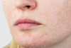  Cara Atasi Efek Buruk dari Skincare Salah Satunya Kulit Mengelupas 