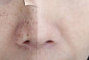 Cara Mengatasi Flek Hitam di Hidung yang Tak Kunjung Hilang