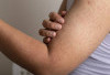 3 Cara Mengatasi Keratosis Pilaris di Badan!