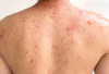 Jerawat di Badan Bikin Resah? Ini Cara Mengatasinya!