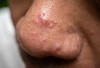 Jerawat Sering Muncul di Area Hidung? Cari Tahu Penyebabnya! 