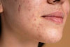 Cara Ampuh Memperbaiki Skin Barrier Rusak Dalam Seminggu 
