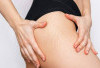 Tak Perlu Dilaser, Ini Cara Alami Hilangkan Stretch Mark