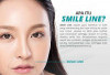 Cara Mengurangi Smile Line Tanpa Operasi