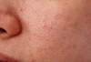 Benarkah Facial Bisa Memperbesar Pori-pori? Ini Faktanya 