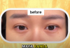 Eye Patch Gel Medis Jadi Solusi Baru Atasi Mata Panda