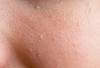 Cara Efektif Hilangkan Tiny Bumps di Wajah Dalam 10 Menit