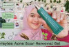   Rekomendasi Krim Penghilang Bekas Jerawat, Ampuh Banget! 