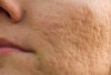3 Skincare Murah Untuk Atasi Kulit Bopeng, Mulai 20 Ribuan!