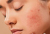 Penyebab Wajah Gatal Setelah Pakai Skincare dan Cara Mengatasinya