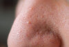 Kenapa Pori-Pori Membesar Setelah Pakai Skincare? Ini Penyebabnya