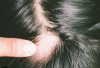 Bukan Pakai Haircare,  Ini Cara Cepat Atasi Rambut Pitak