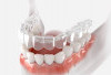 5 Manfaat Merapikan Gigi Dengan Clear Aligner!
