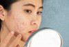 Bahan Dapur Obat Jerawat Alami Paling Cepat Hilang