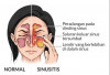 Obati Sinusitis Dengan Menggunakan 5 Bahan Alami Ini