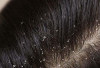  Rambut Gatal dan Berketombe? Ini 5 Penyebabnya!